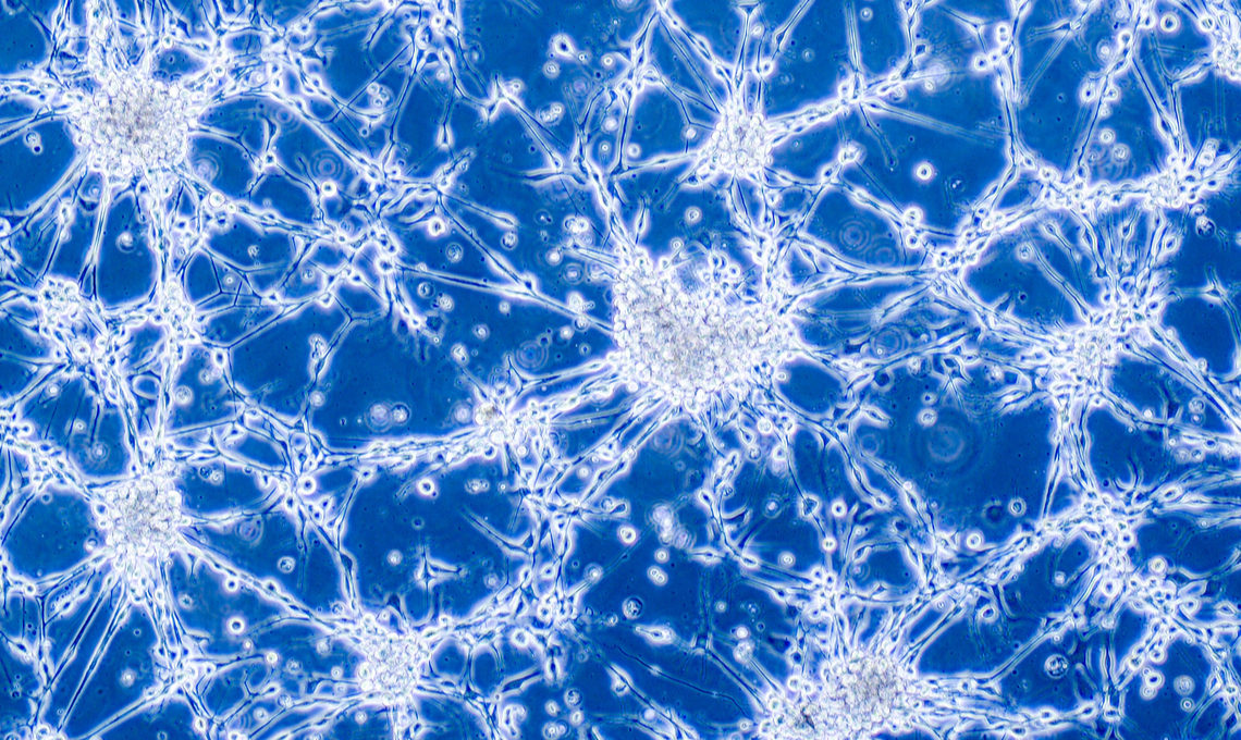 Glioblastoma brain cancer cells under microscope